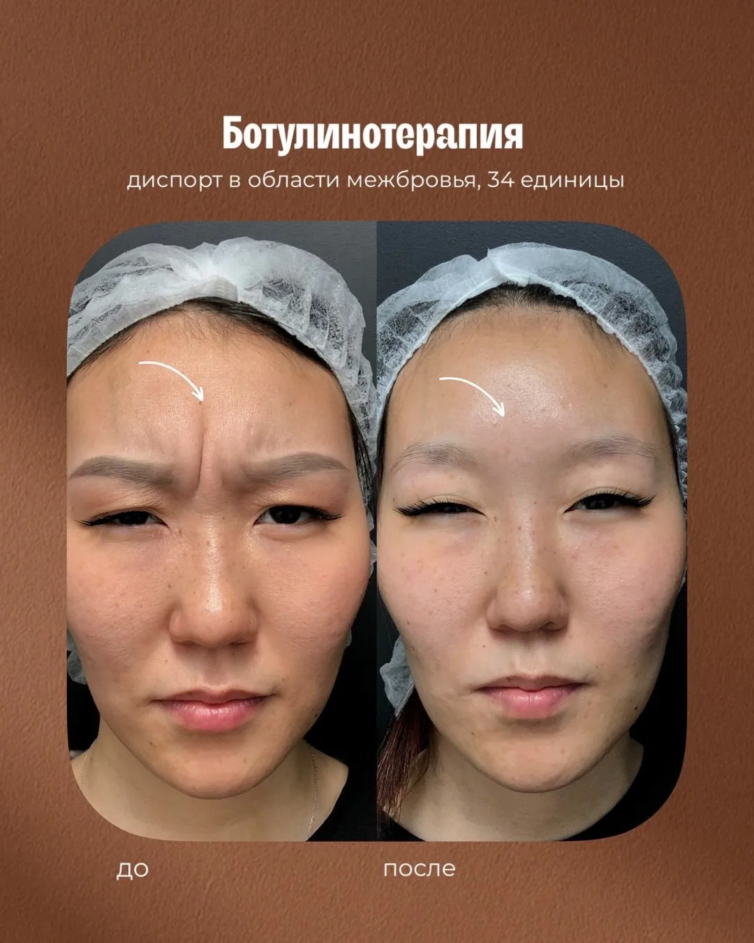 Межбровье —это та самая зона, которая чаще всего выдаёт возраст ✨