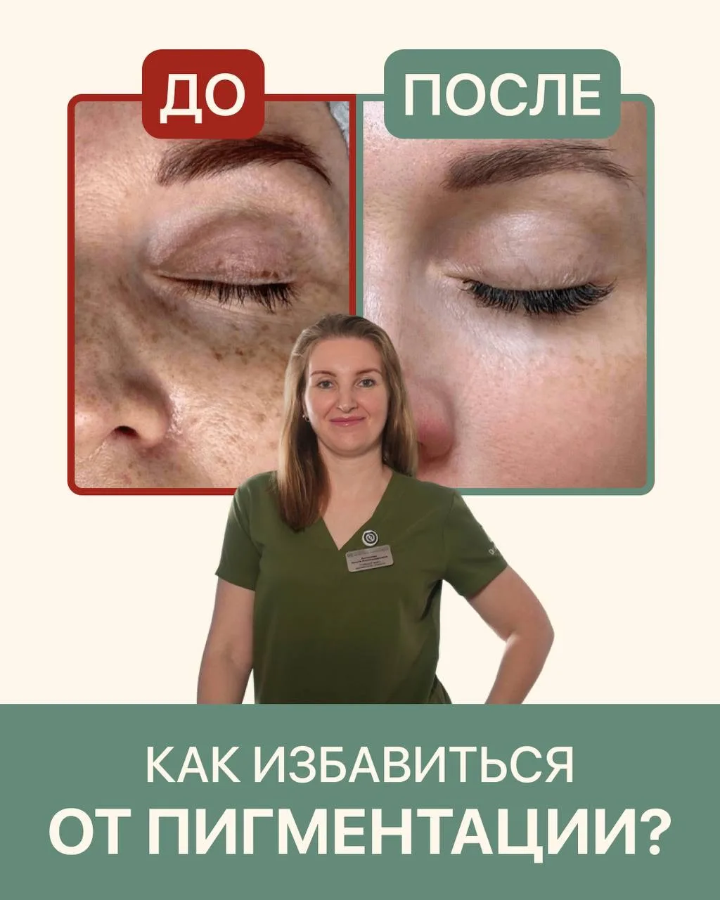 КАК ИЗБАВИТЬСЯ ОТ ПИГМЕНТАЦИИ?

Пигментация — это не самостоятельное заболевание, а реакция кожи. По