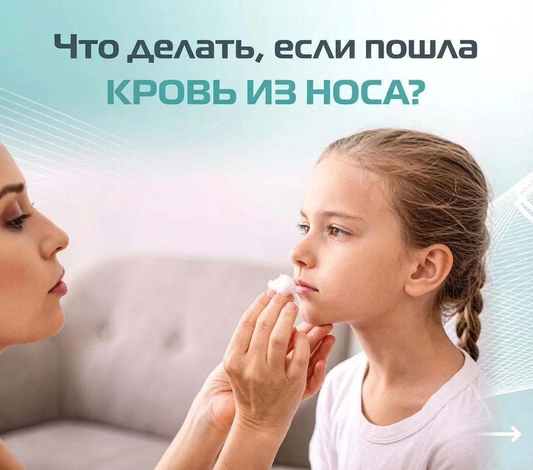 🩸 НОСОВОЕ КРОВОТЕЧЕНИЕ: ЗАПРОКИДЫВАТЬ ГОЛОВУ НЕЛЬЗЯ!