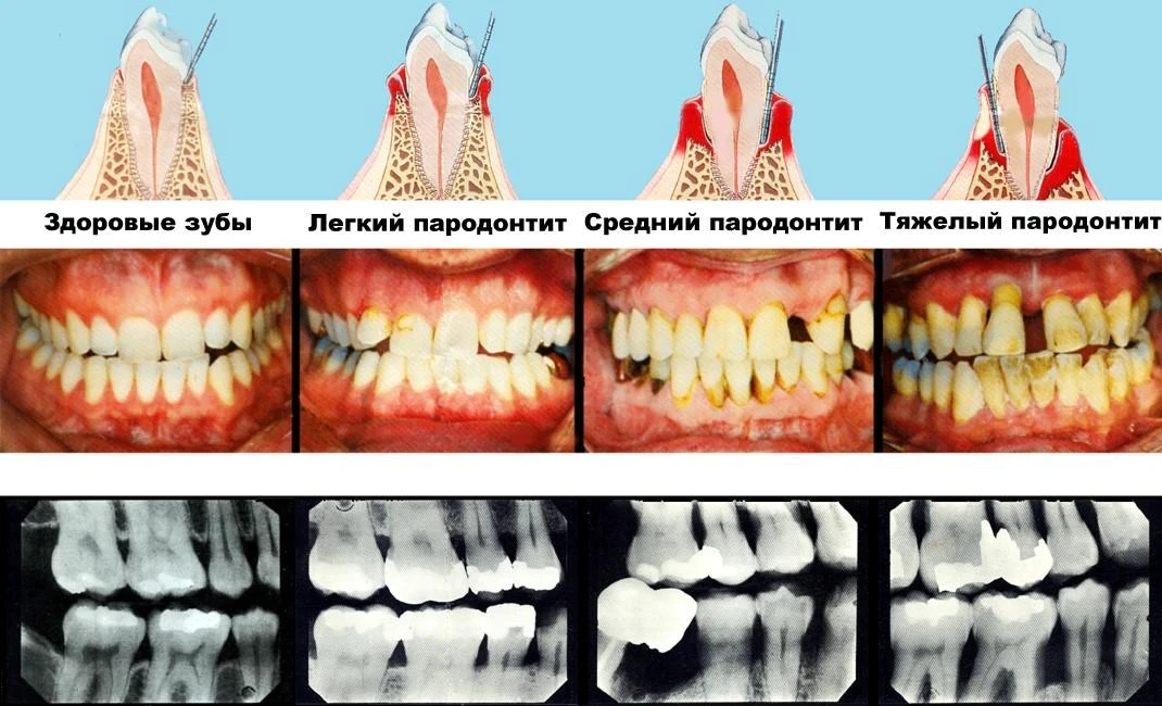 Пародонтит повышает риск инфаркта: связь доказана  Бактерии Porphyromonas gingivalis (основные возбу