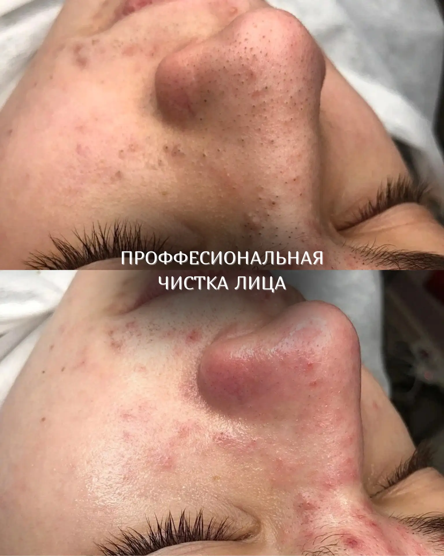 Чистка лица — это не только про чистую кожу, но и про правильный уход за ней ✨