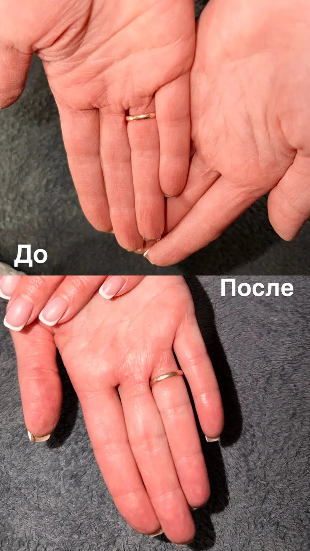 После огорода и воды с моющими средствами кожа рук очень сухая, появляются даже трещинки.
