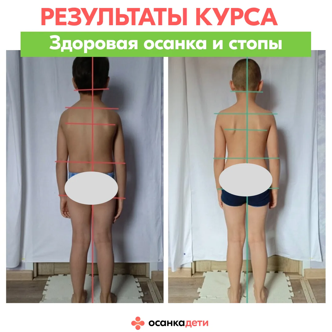 Его «до» — это стельки, «рукопашка» и ….  сутулость. После — смотрите в карусели результаты Савелия 