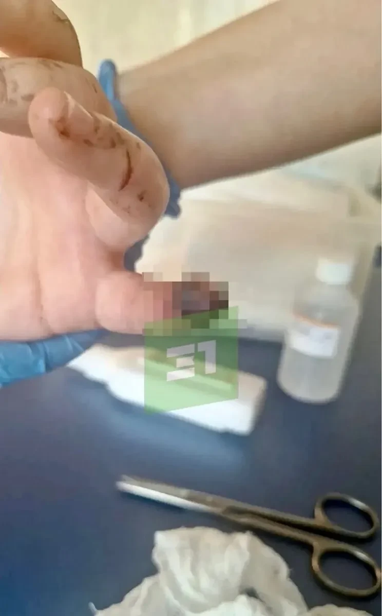 В Челябинске школьница лишилась части мизинца на детской площадке