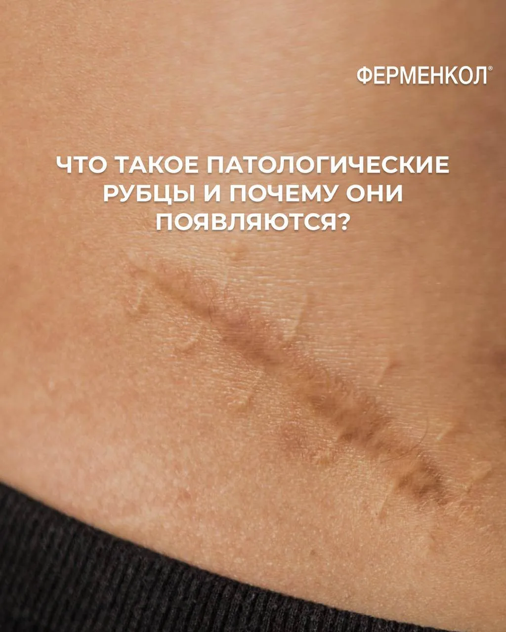 Что такое патологические рубцы и почему они появляются?