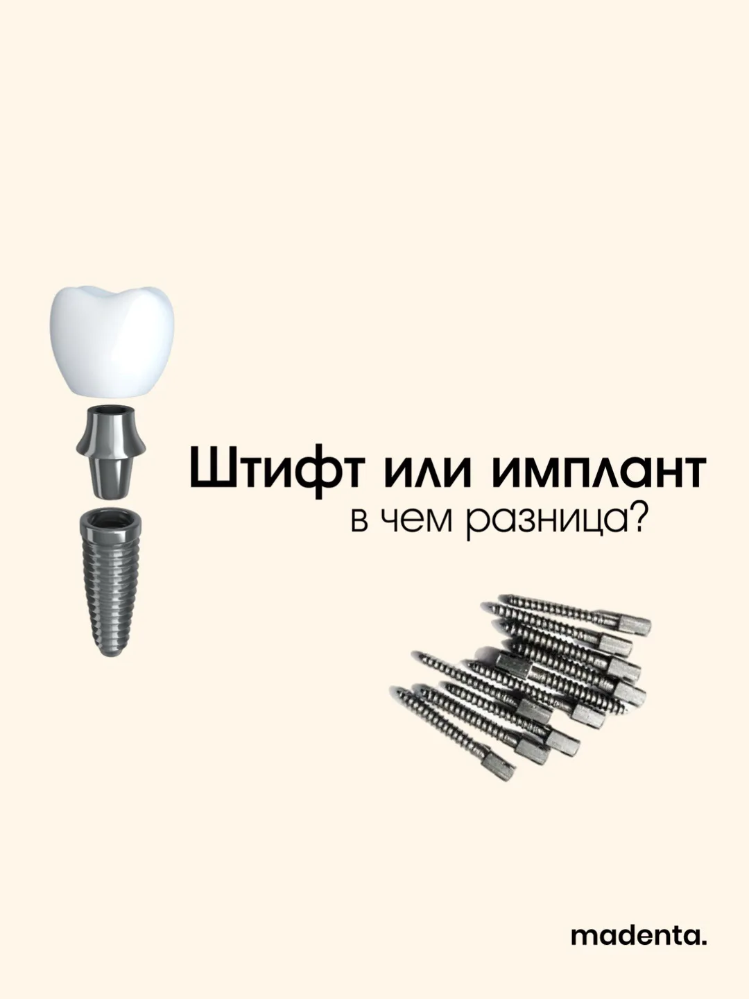 Штифт или имплант: в чём разница?