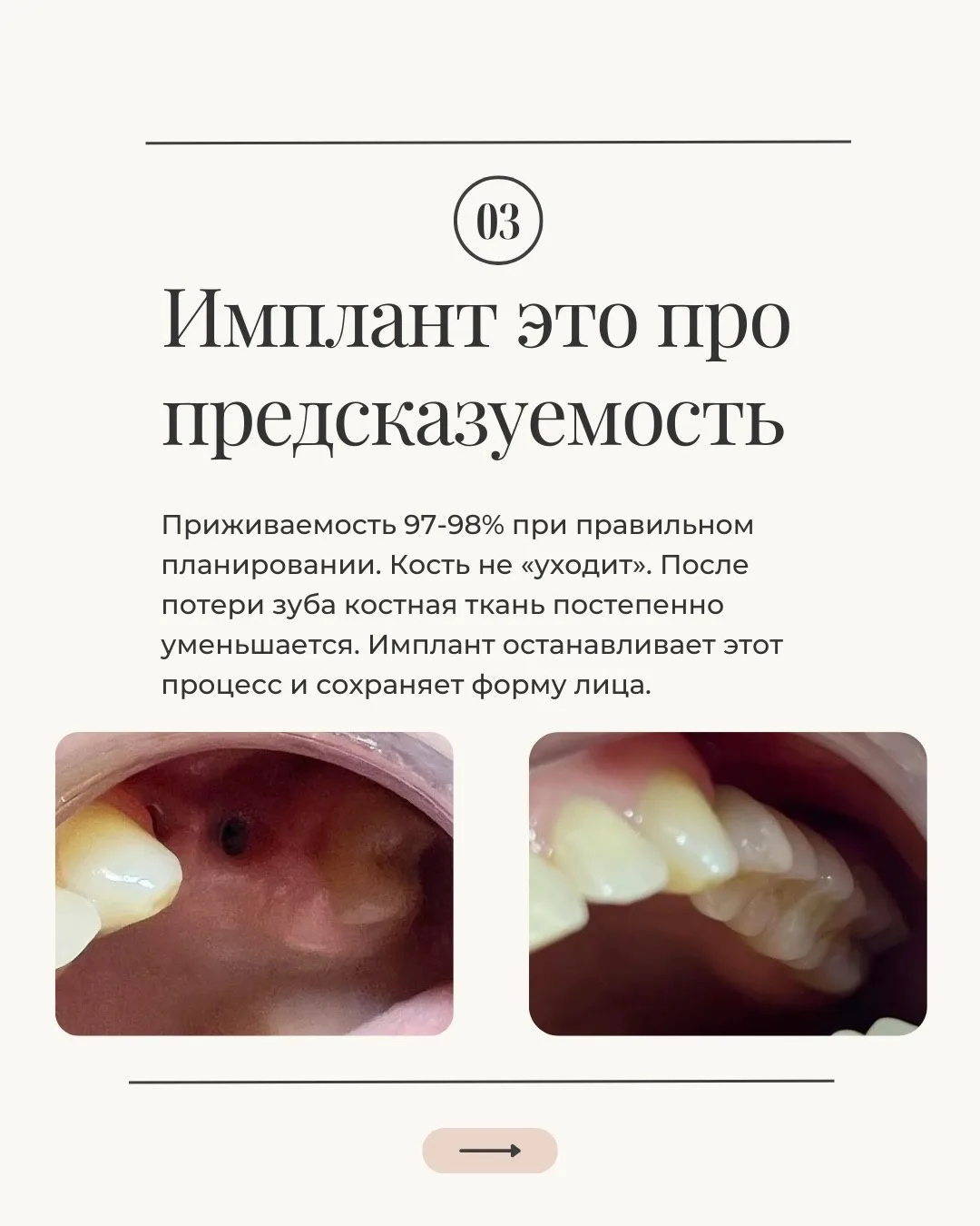 🦷 Имплантация — это не так страшно и сложно, как многие представляют.