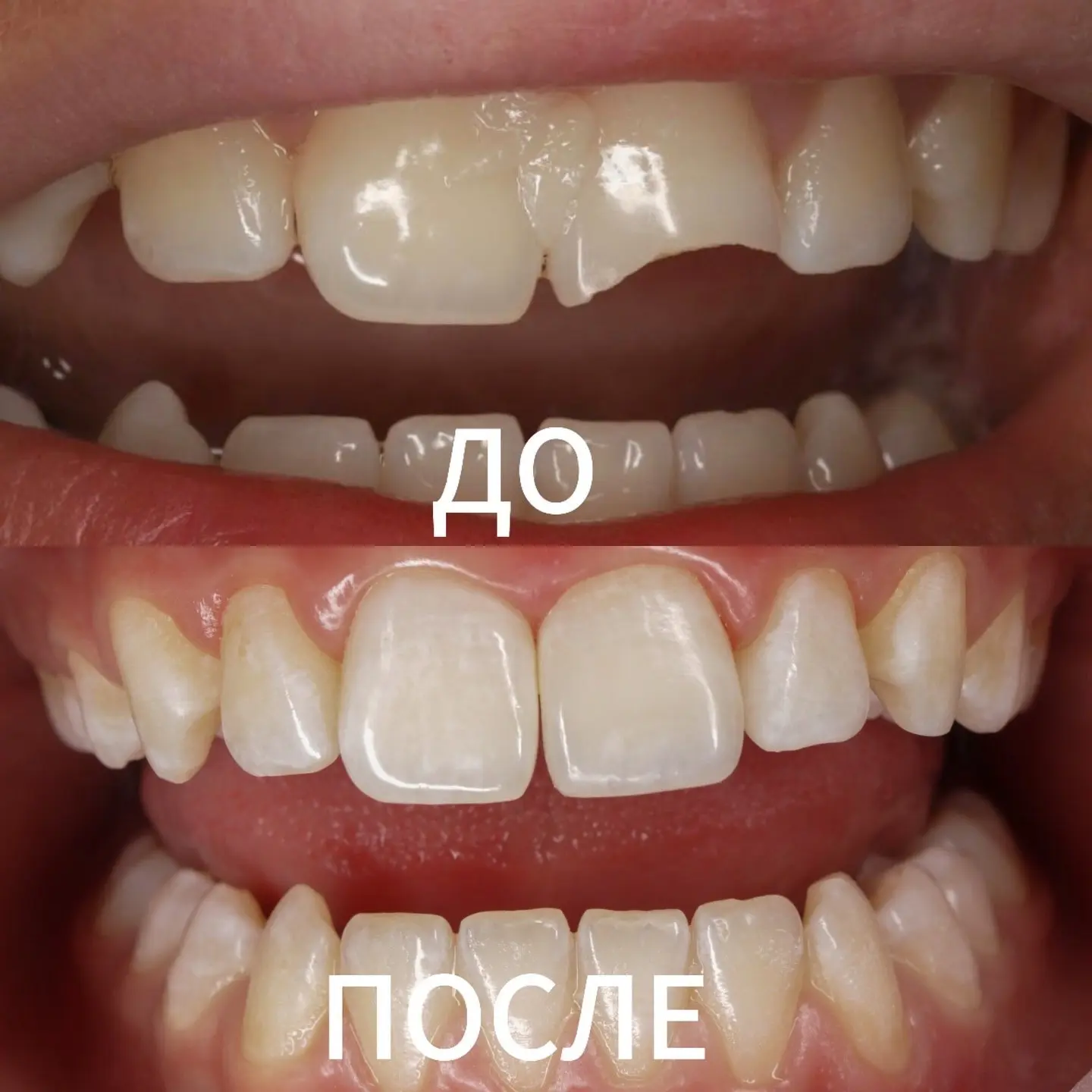 Почему после травмы зуба важно не просто восстановить скол❓