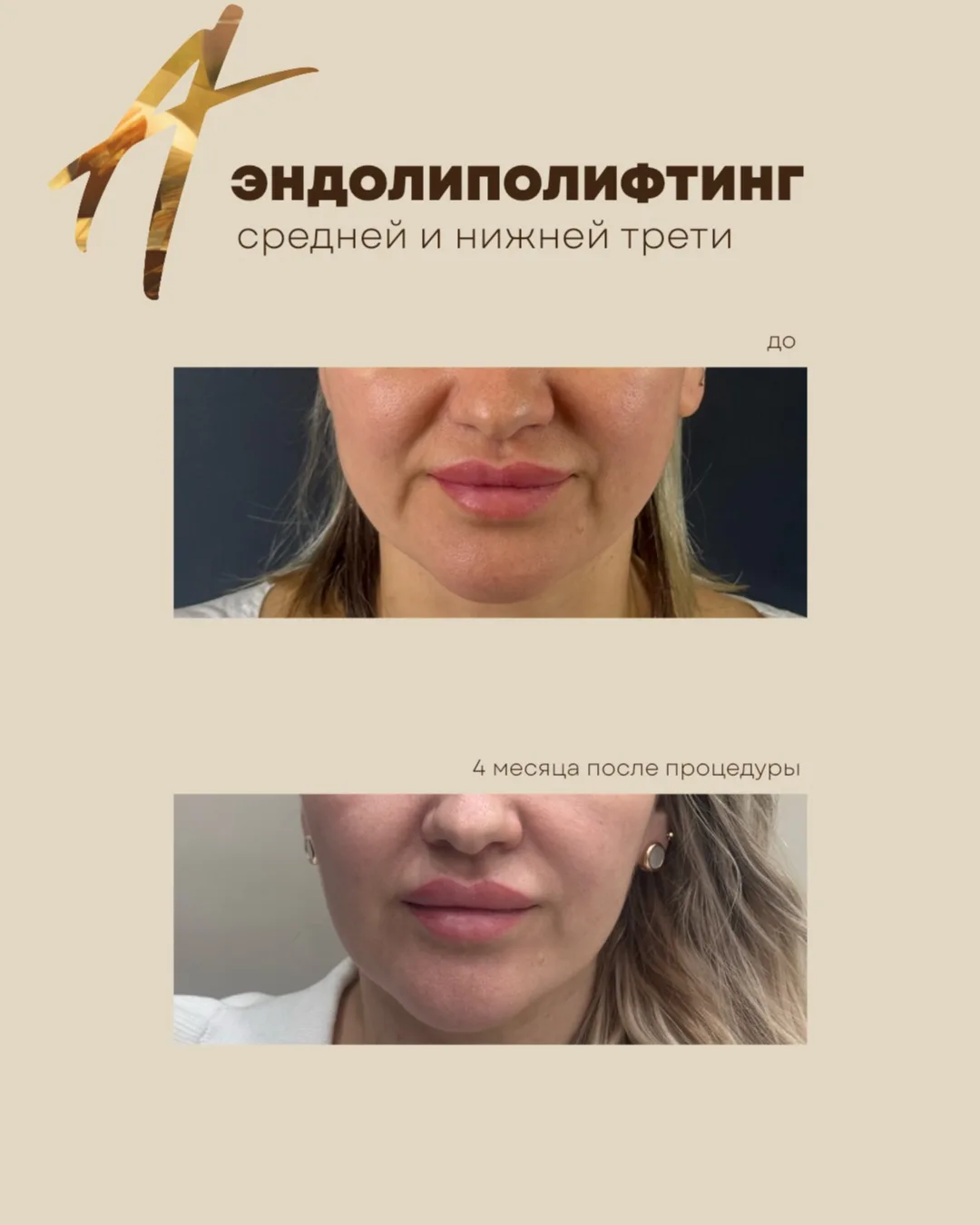 Устали колоть липолитики и не видеть результат? 👇🏻