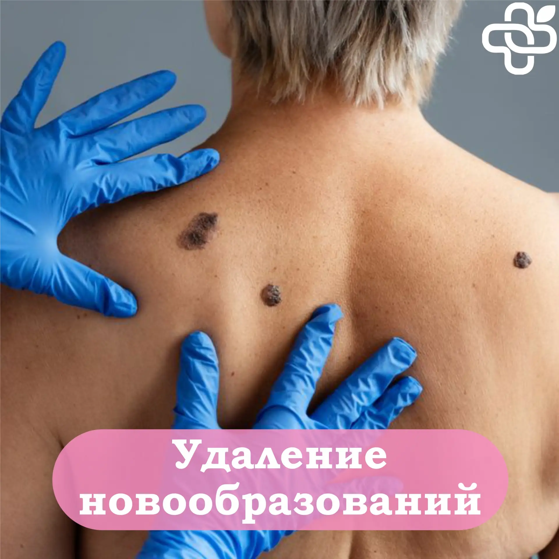❓ Раздражает родинка, которая цепляется за одежду? Беспокоят появившиеся папилломы?   🩺 Наши специал