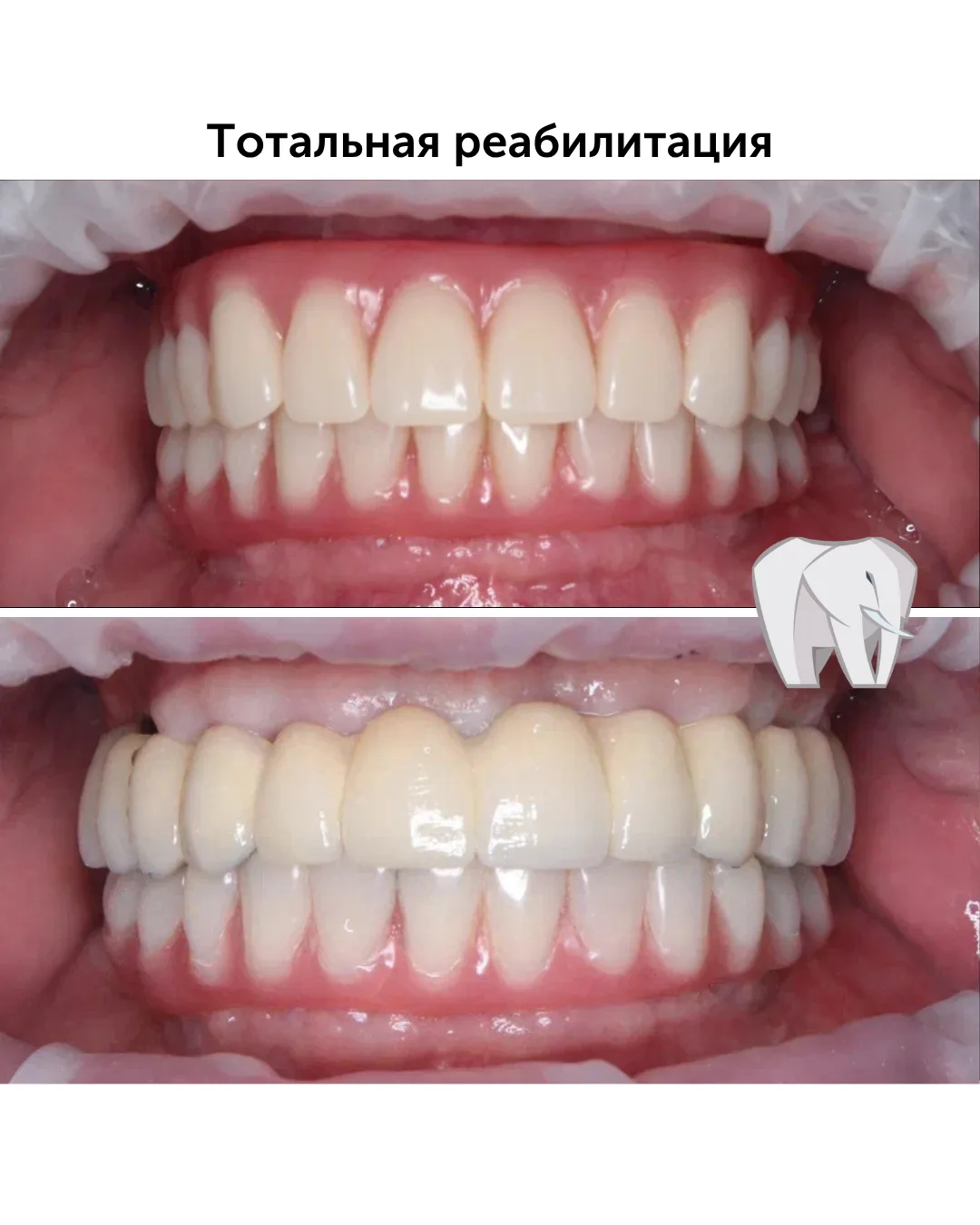 Самый надежный вариант протезирования при полном отсутствии зубов - протезирование на и...