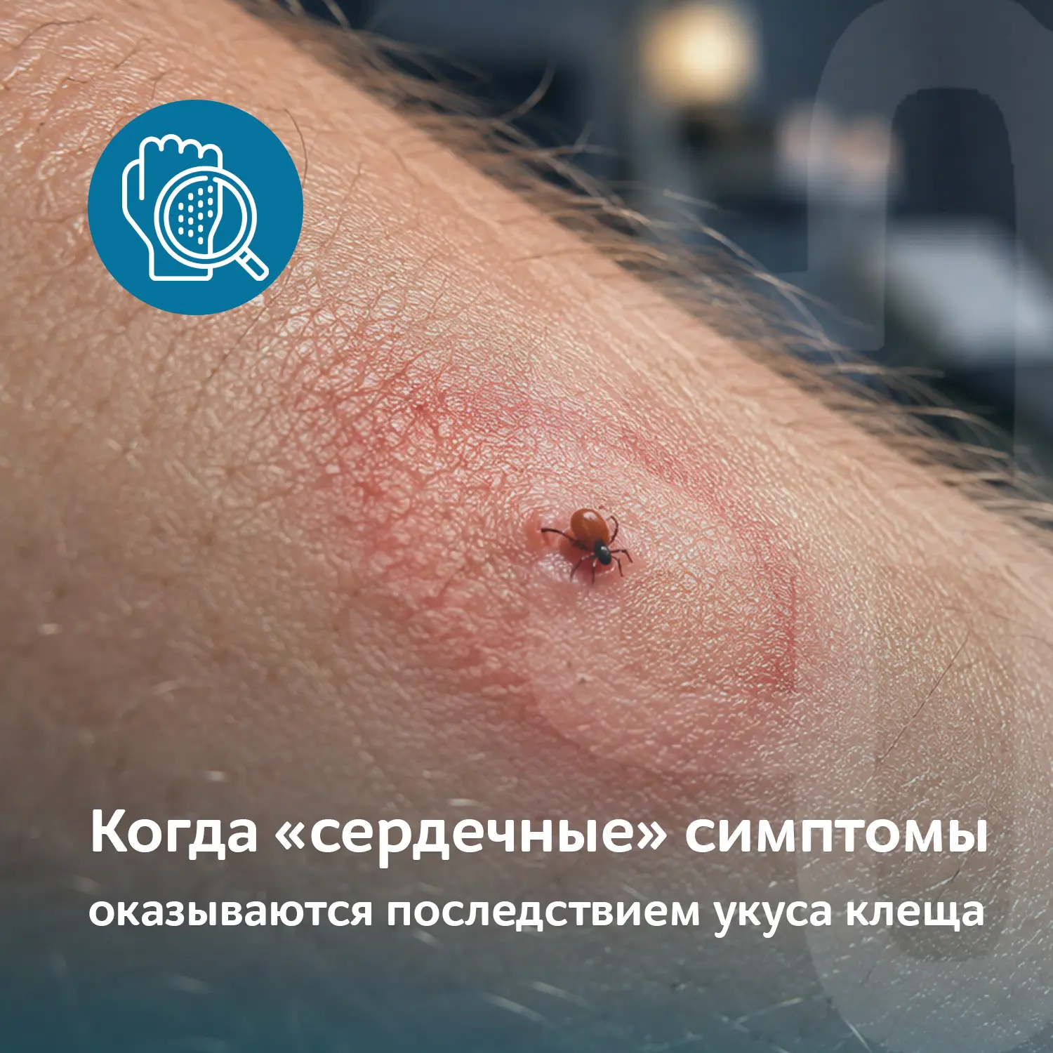 ❤ Когда «сердечные» симптомы оказываются последствием укуса клеща