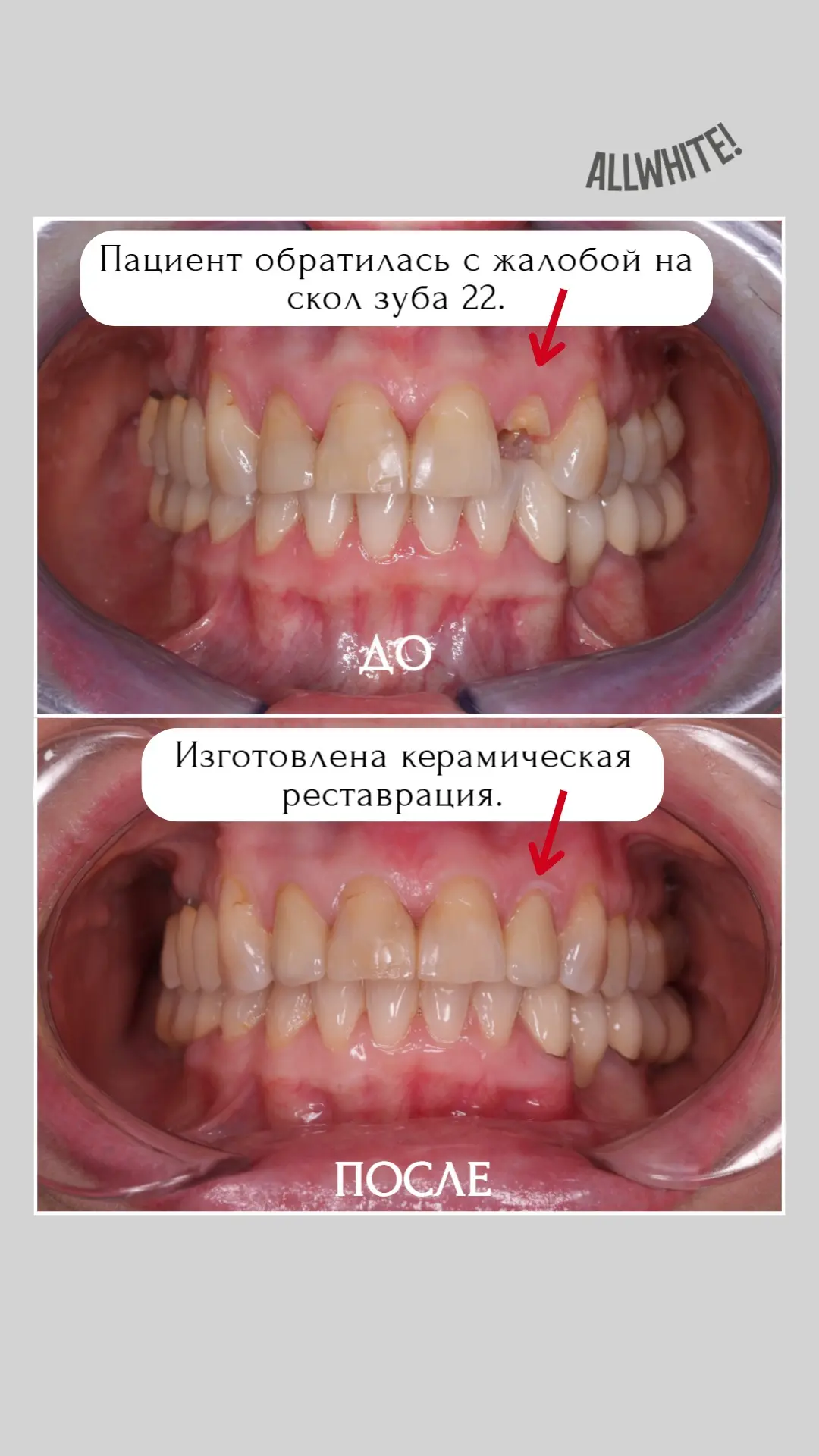 Пациент обратилась с жалобой на скол зуба 22. 
Было проведено эндодонтическое  лечение , зуб восстан