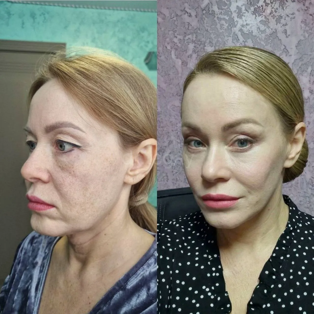 Почти 3 месяца после комплексного омоложения✨