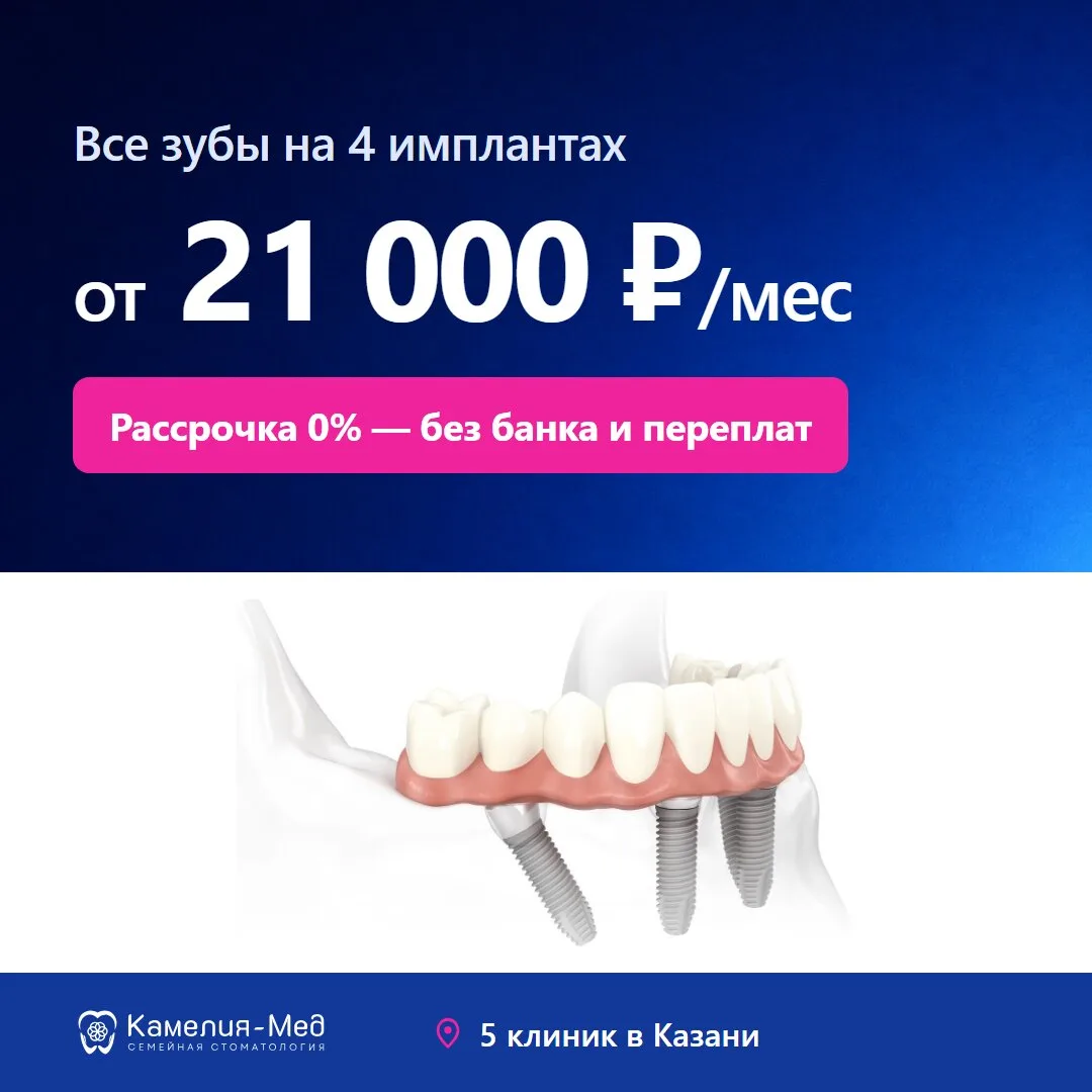 Все зубы на 4 имплантах — от 21 000 ₽ в месяц