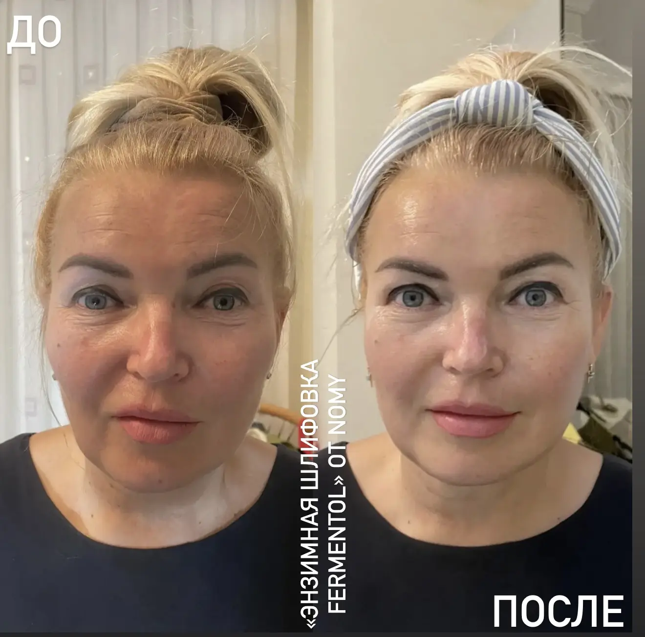 ПРОТОКОЛ «ЭНЗИМНАЯ ШЛИФОВКА»