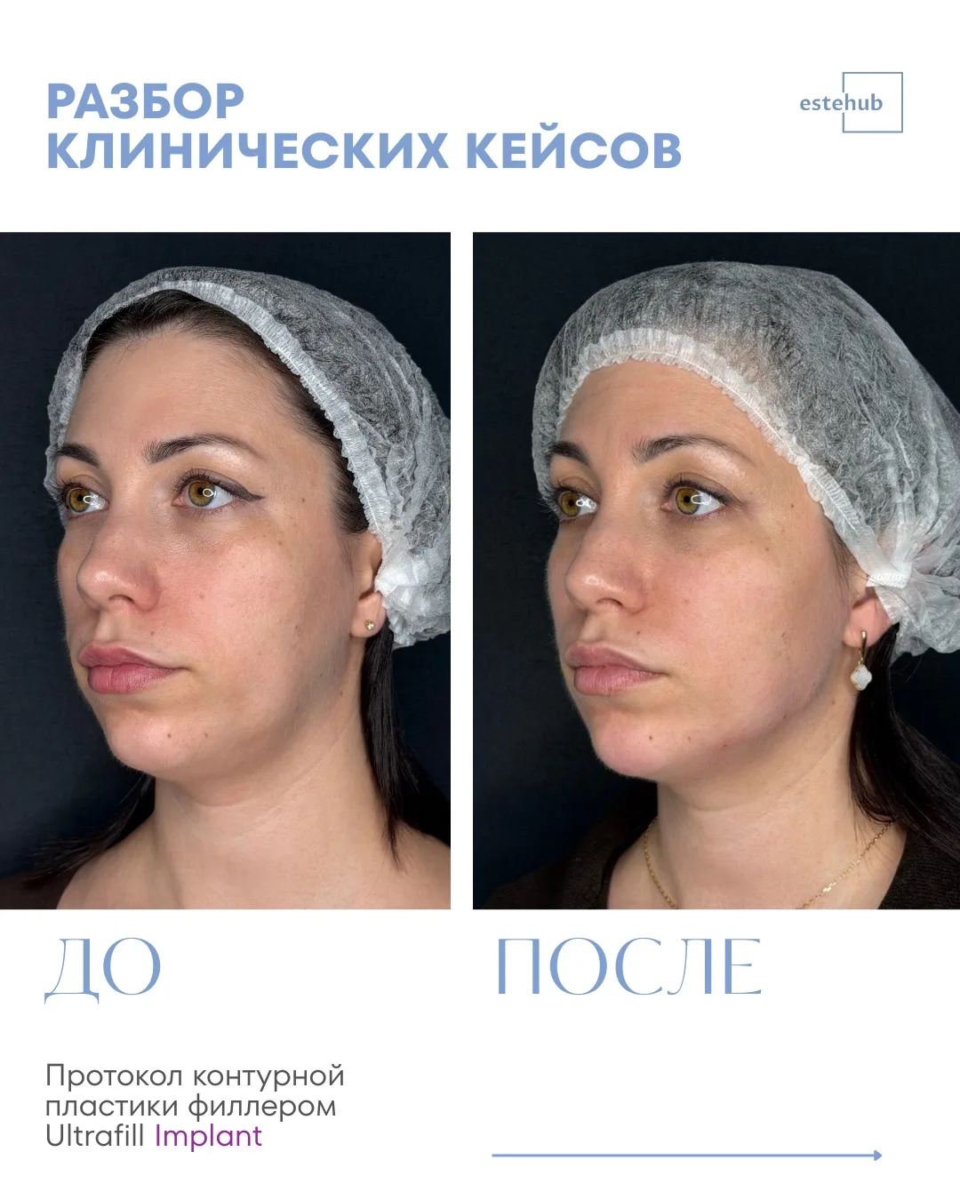 Разбор клинического кейса | Контурная пластика филлером Ultrafill Implant