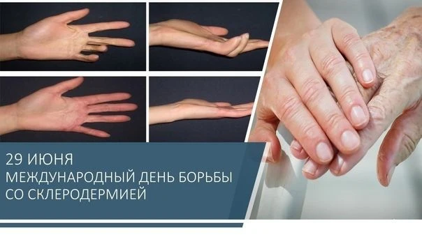 Всемирный день склеродермии отмечается ежегодно 29 июня. Эта дата призвана привлечь внимание обществ