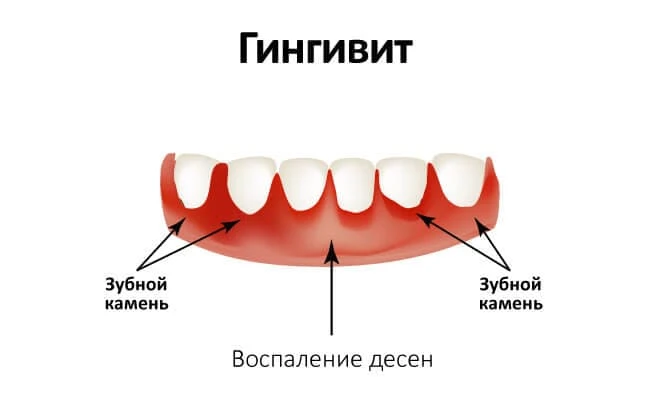 Гингивит: не лечить нельзя  Гингивит — это воспаление десны из-за налёта. Симптомы: кровоточивость п