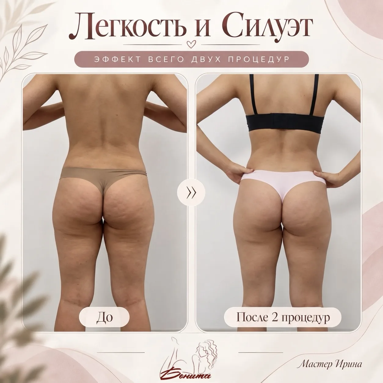 На фото — результат всего двух процедур программы «Лёгкость и Силуэт». Но самое интерес...