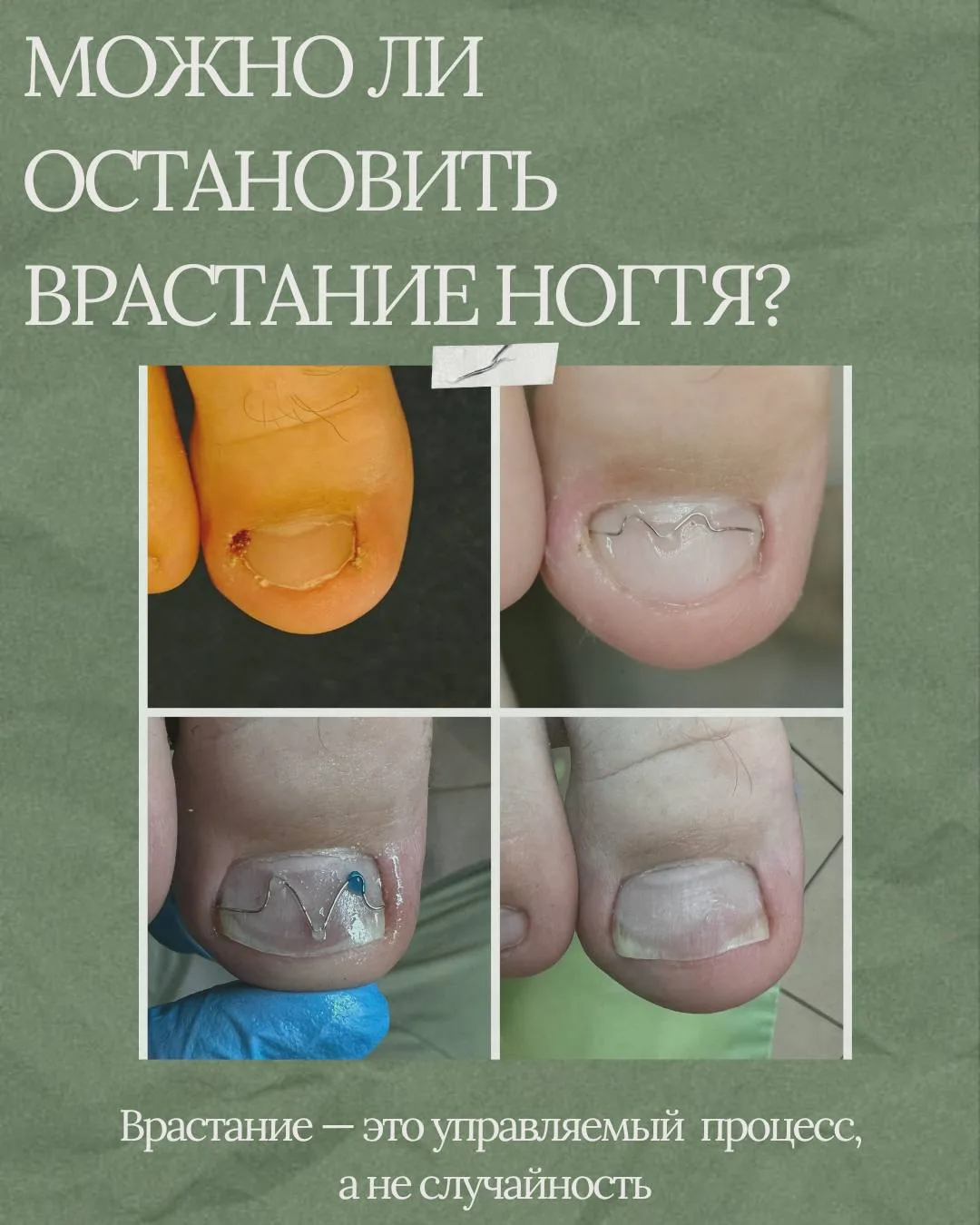 Можно ли сделать так, чтобы ноготь никогда больше не врастал? 🤔

Часто звучит ожидание, что существ