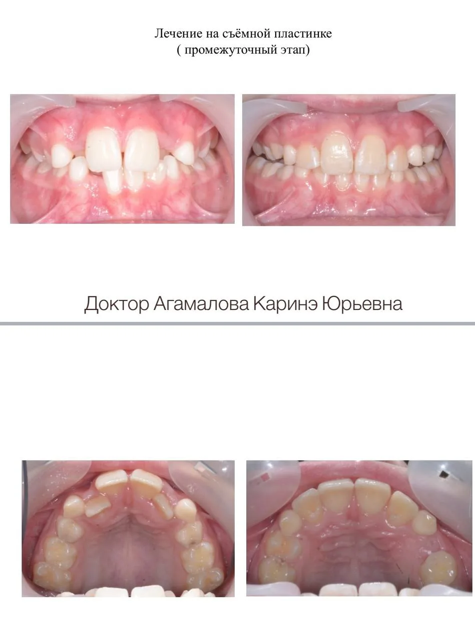 😬 «Вырастут все постоянные зубы — тогда и поставим брекеты»: почему эта ошибка стоит с...