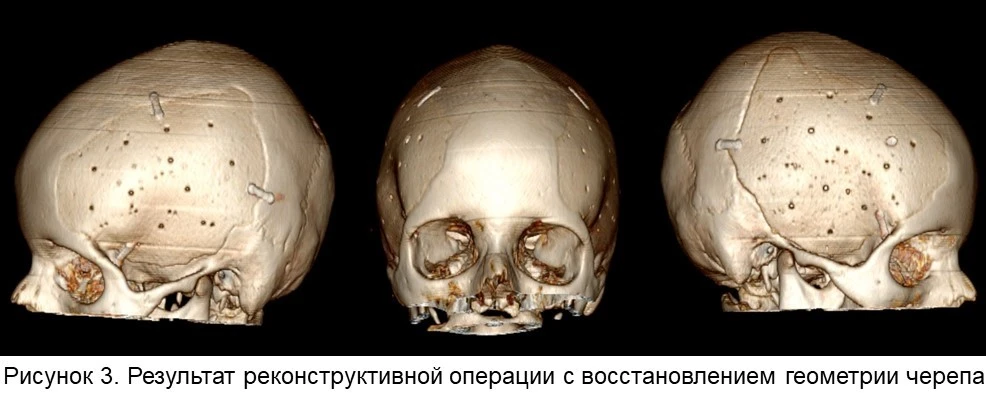 🧠 Современные возможности нейрохирургии и нейрореанимации позволяют не только спасать ранее практиче