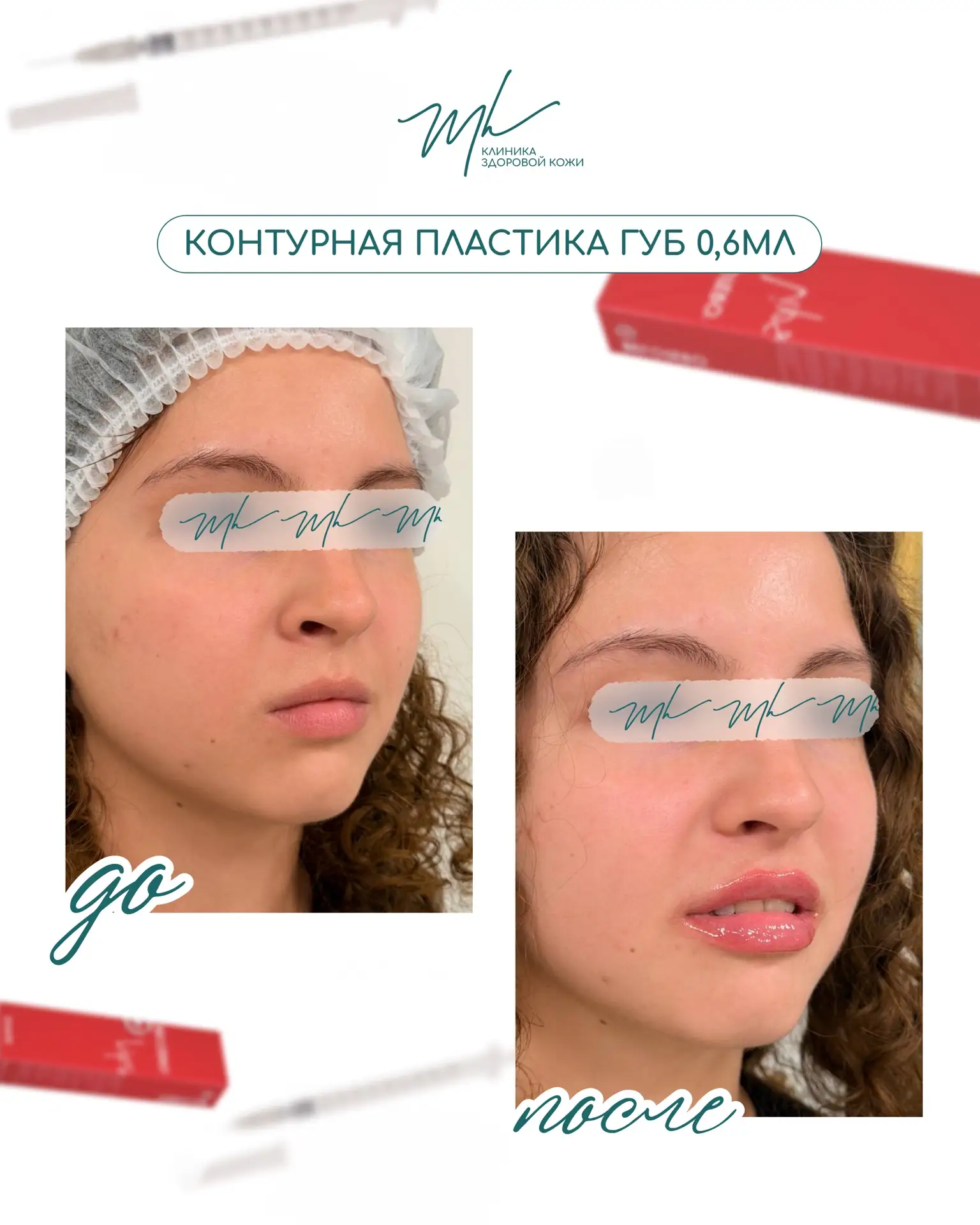 Преображение нашей прекрасной гостьи 💉 работа косметолога Кристины Могильной.