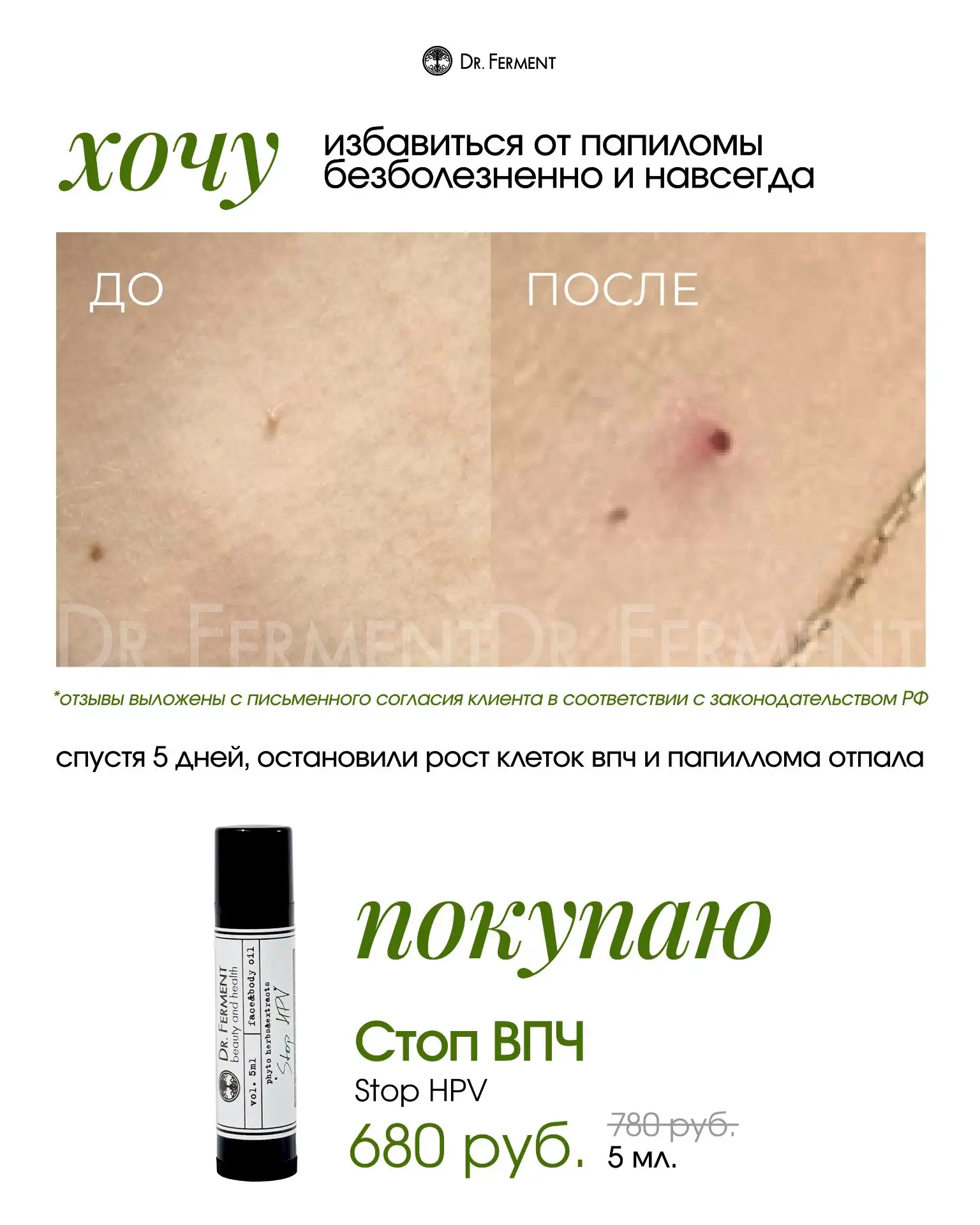 ПАПИЛЛОМЫ И БОРОДАВКИ