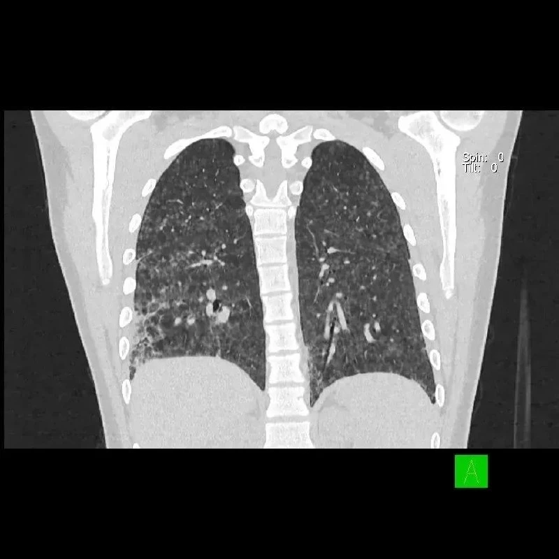 🚭 Вейп едва не стоил жизни 16‑летнему подростку в Кузбассе
