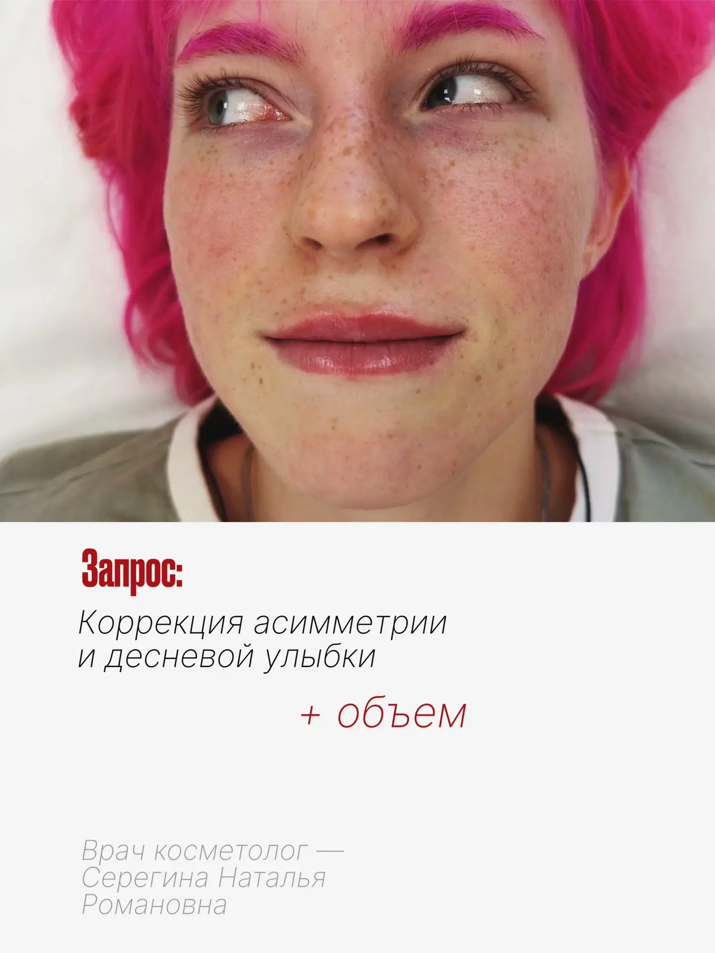 История одной гингивальной улыбки🩷