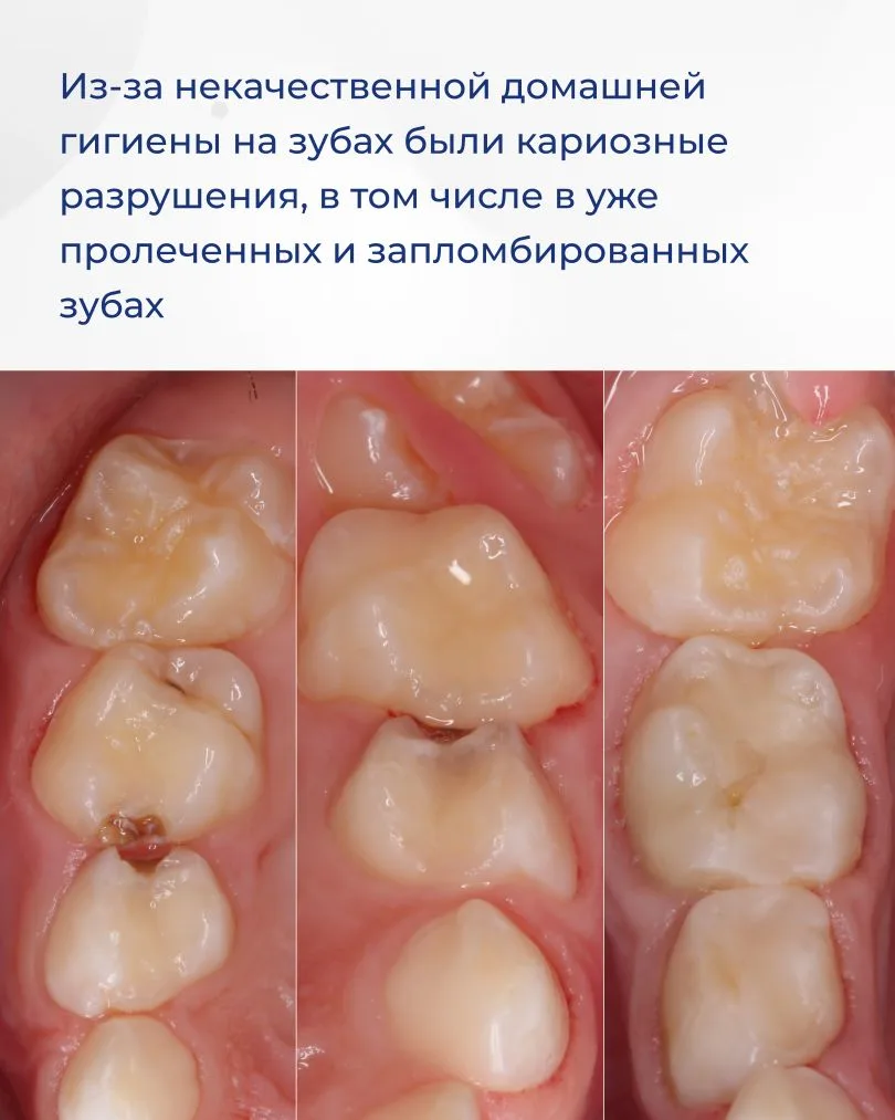 Недостаточно тщательная домашняя гигиена может привести к множественному поражению зубов. Именно это