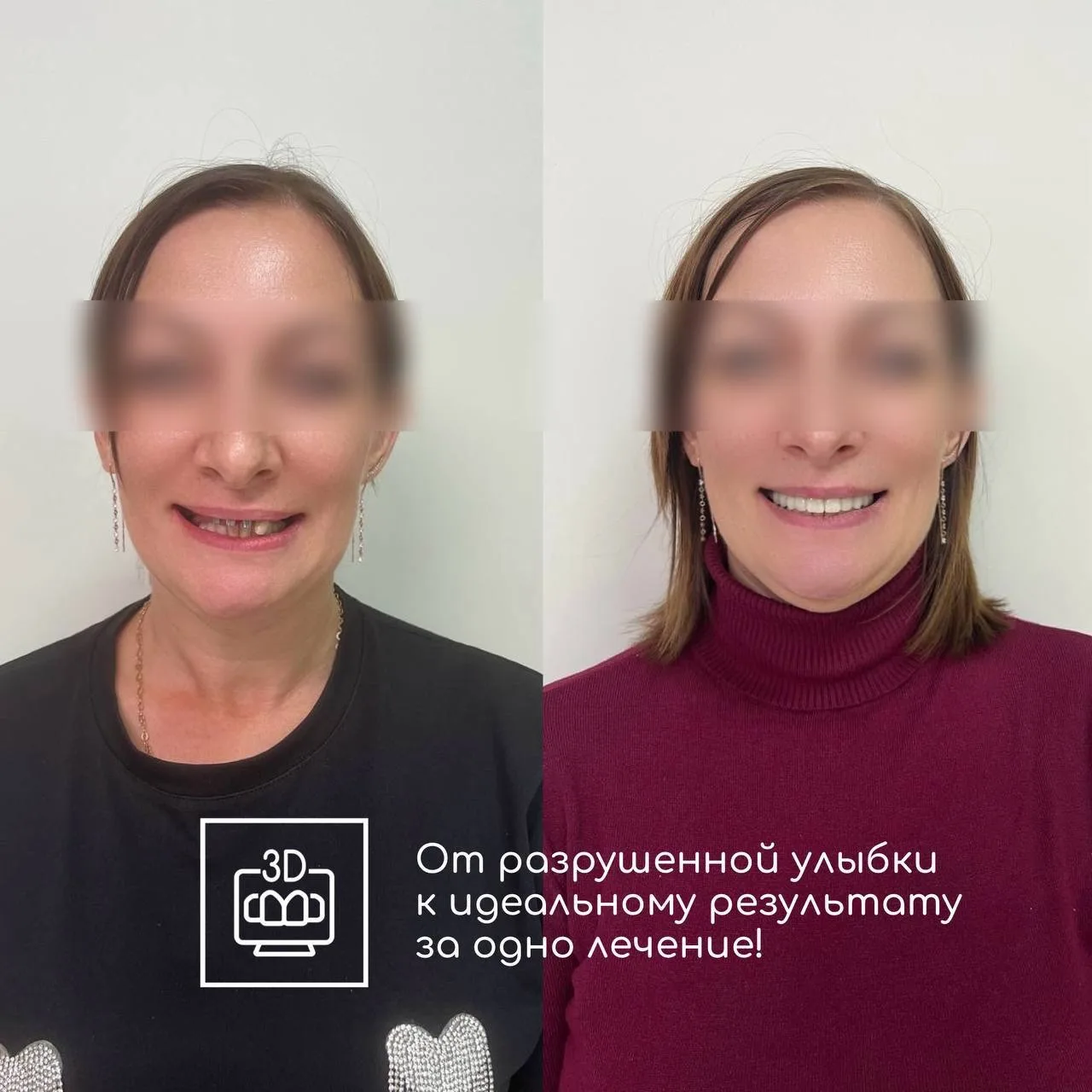 💎 Наш кейс: от разрушенной улыбки к идеальному результату за одно лечение!

Пациентка обратилась к 