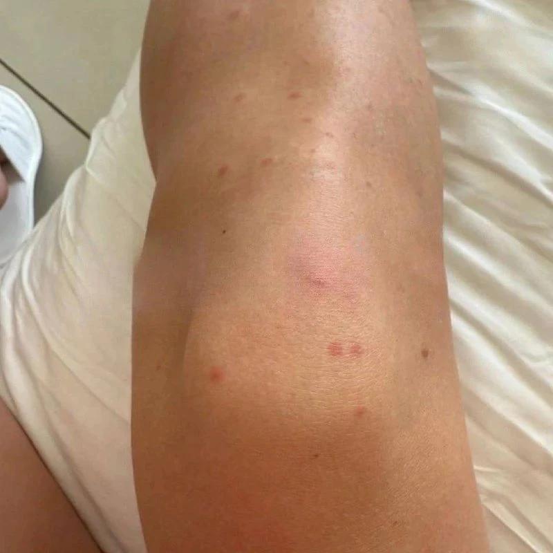 Тюменцы привезли из отпусков малярию и лихорадку Денге