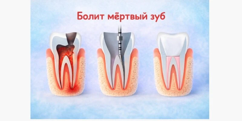Миф: «Мёртвый зуб болеть не может».  Ещё как может, только это уже не нерв орёт, а кость вокруг.  По