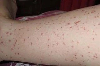 👨‍⚕️В России зафиксирован рост случаев «зуда купальщика» — заболевание выявили уже в восьми региона