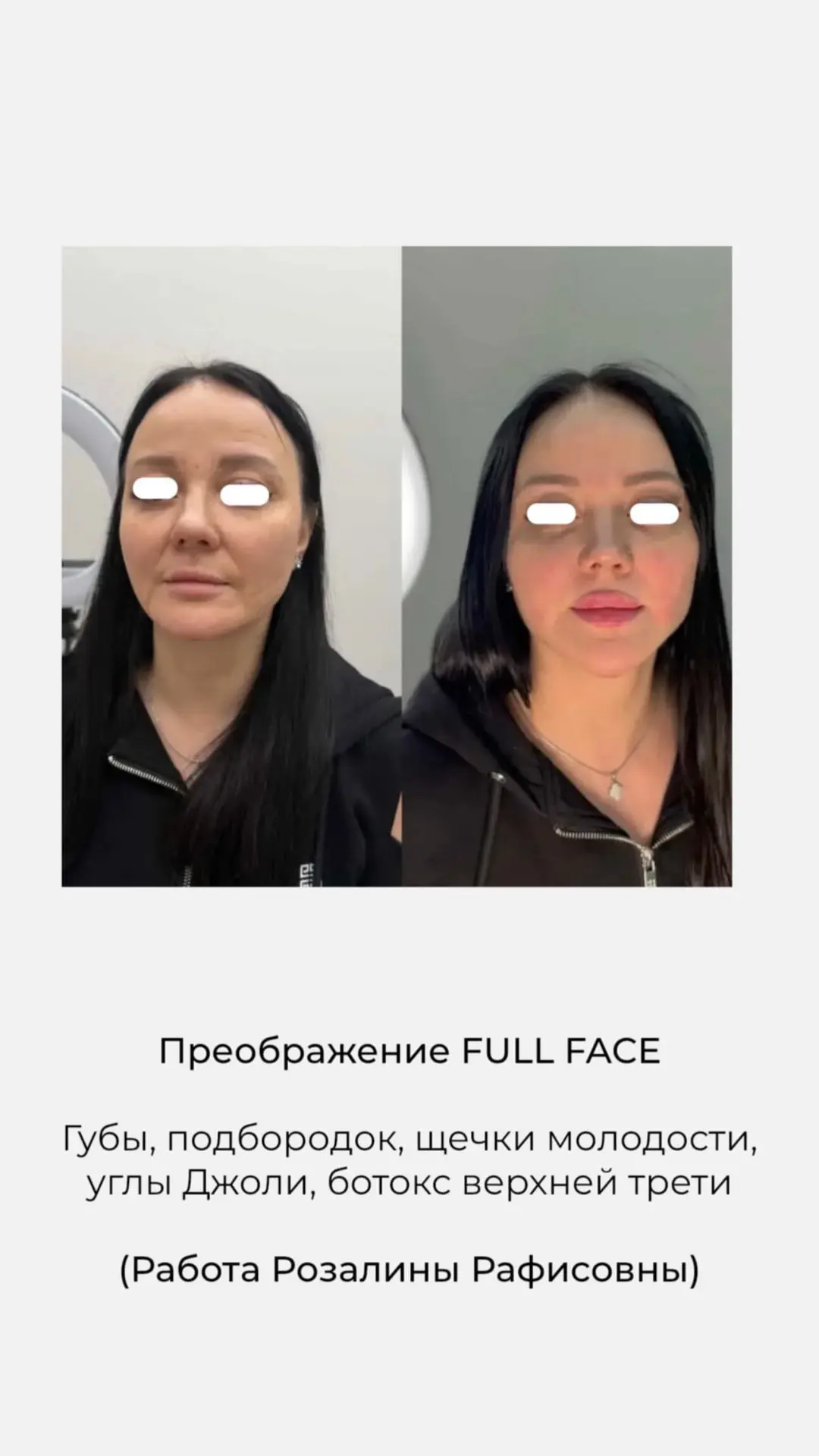 У косметолога Розалины можно сделать контурную пластику губ всего за 10900 😍
