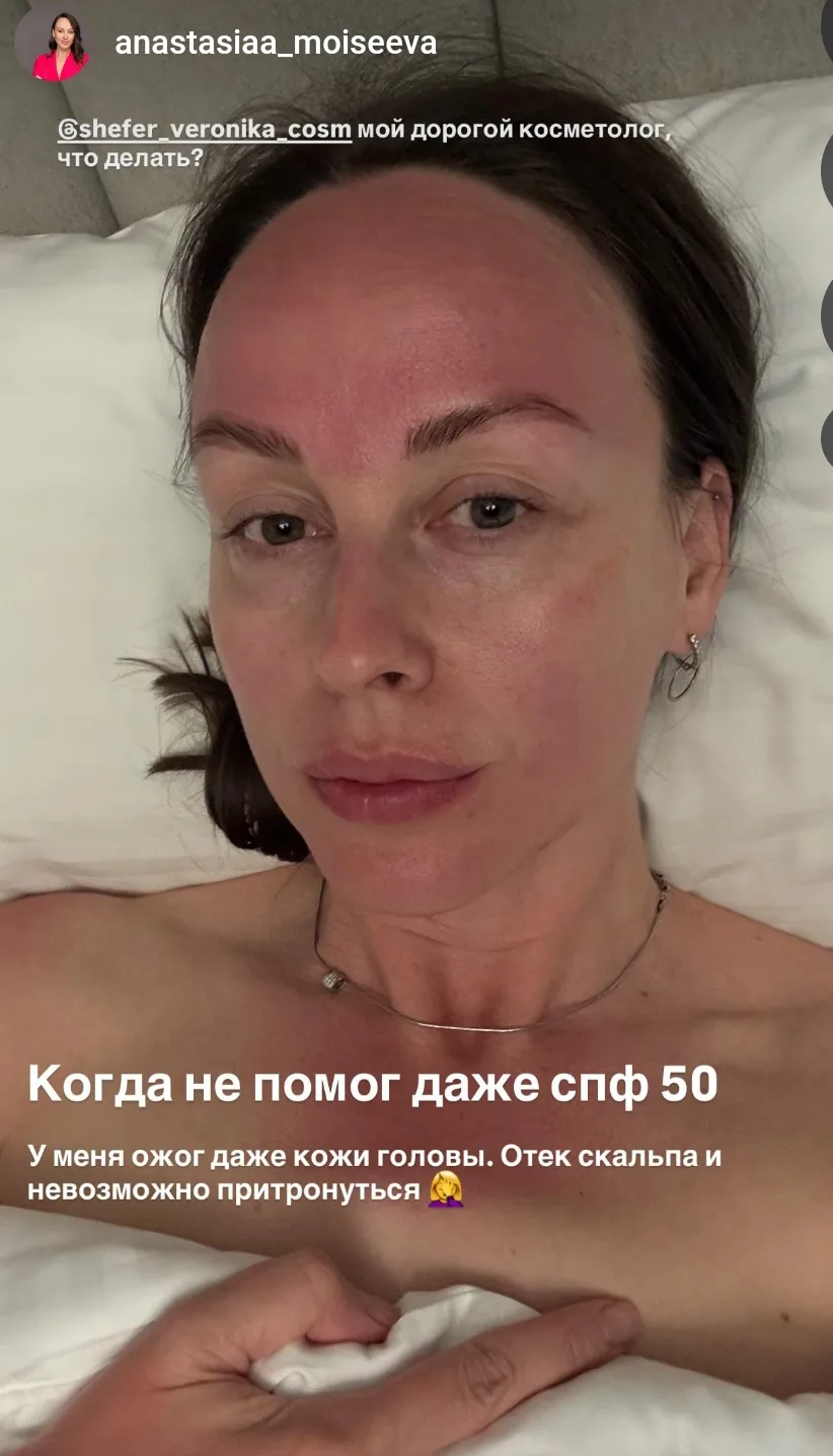 КАК ВОССТАНОВИТЬ КОЖУ, ЕСЛИ ОБГОРЕЛА НА СОЛНЦЕ ?