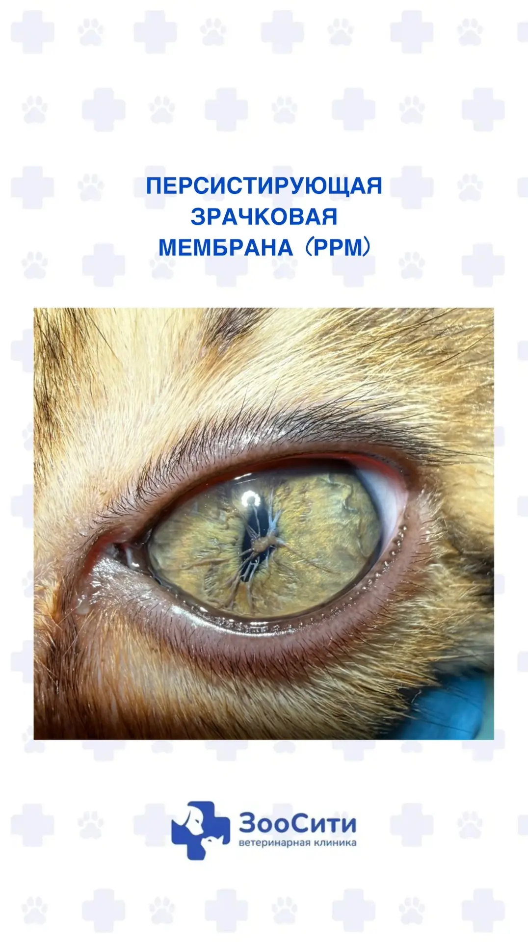 👁️Персистирующая зрачковая мембрана (ПЗМ, или PPM — persistent pupillary membrane) — э...