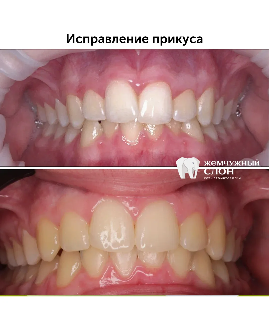 Убрали меньше чем за 1 год незначительную скученность с помощью безлигатурных брекетов.