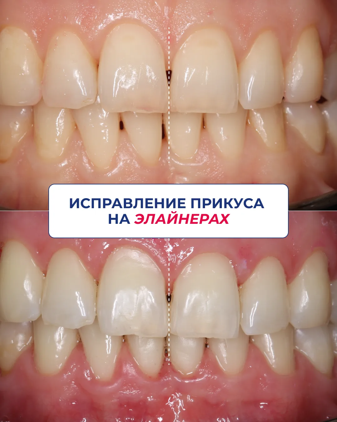 Ортодонтическое лечение на элайнерах — это про современный подход и точное прогнозирова...