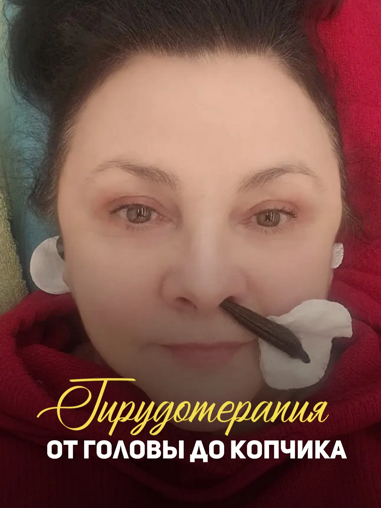 💚 Гирудотерапия: от головы до копчика. Почему метод работает системно?