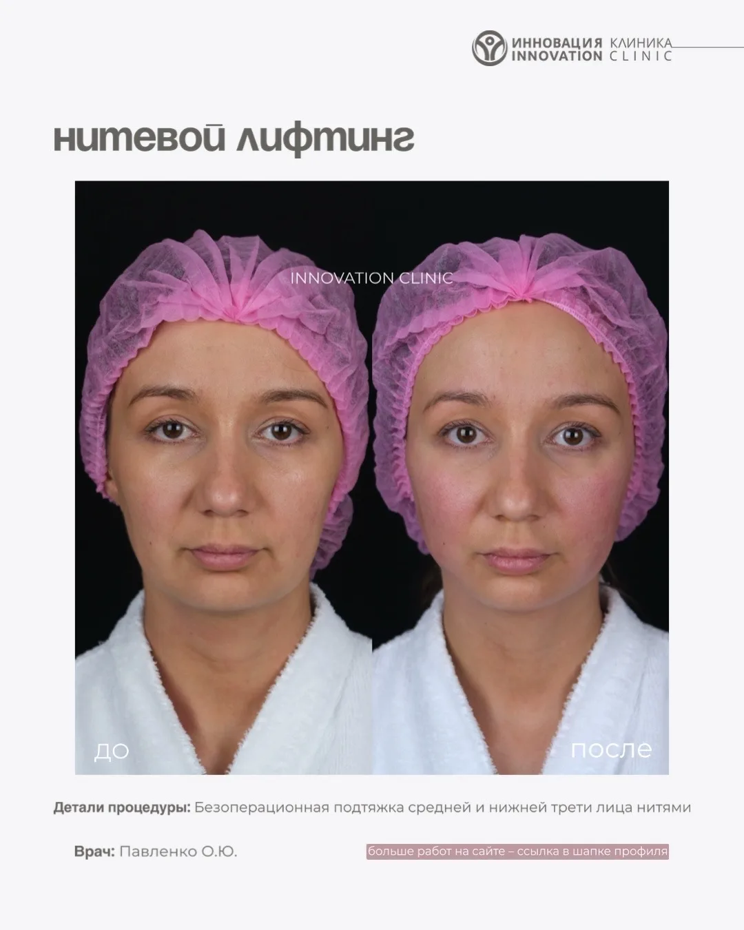 Результаты нитевого лифтинга – больше работ на сайте innovation-clinic.ru