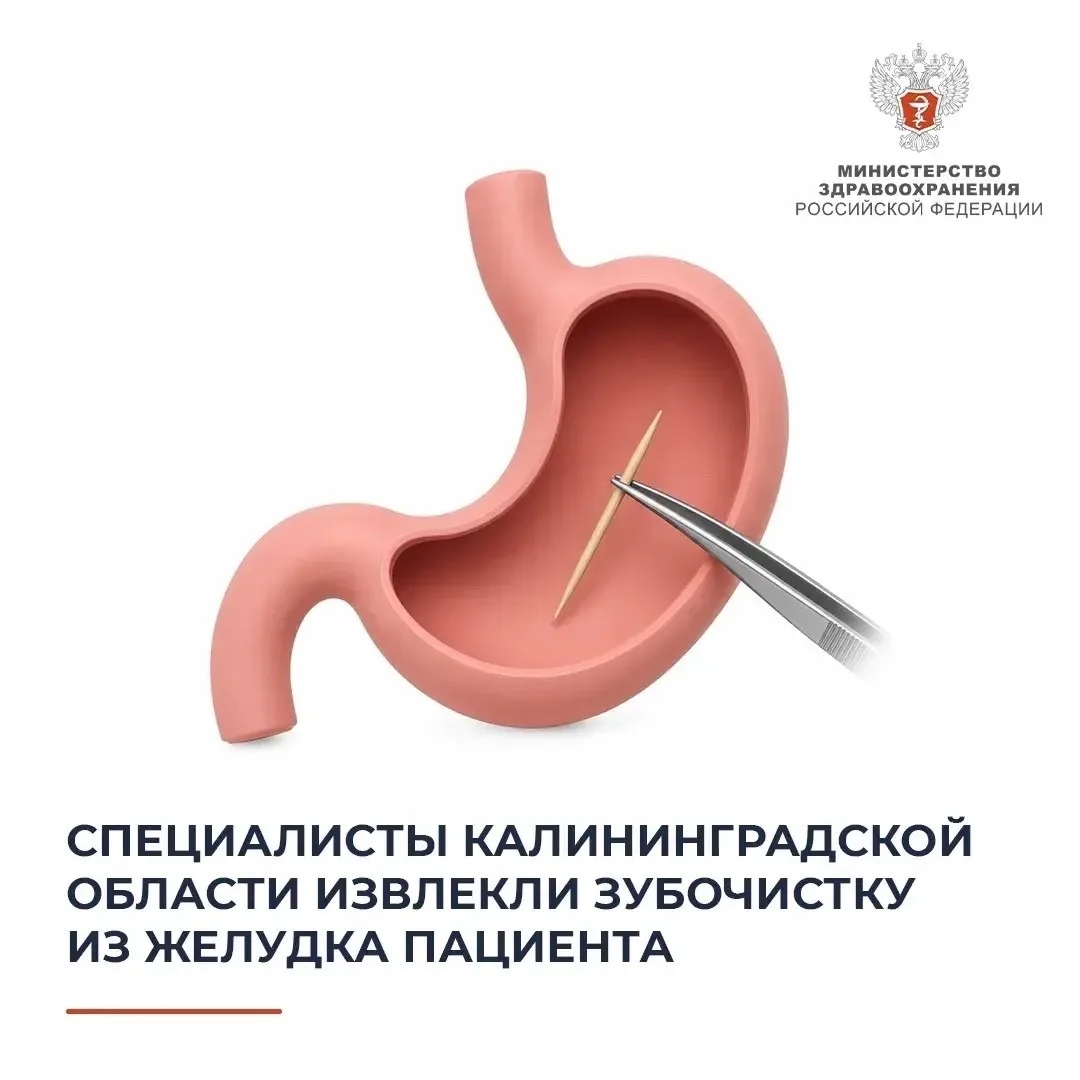 🩺 Специалисты Калининградской области извлекли зубочистку из желудка пациента