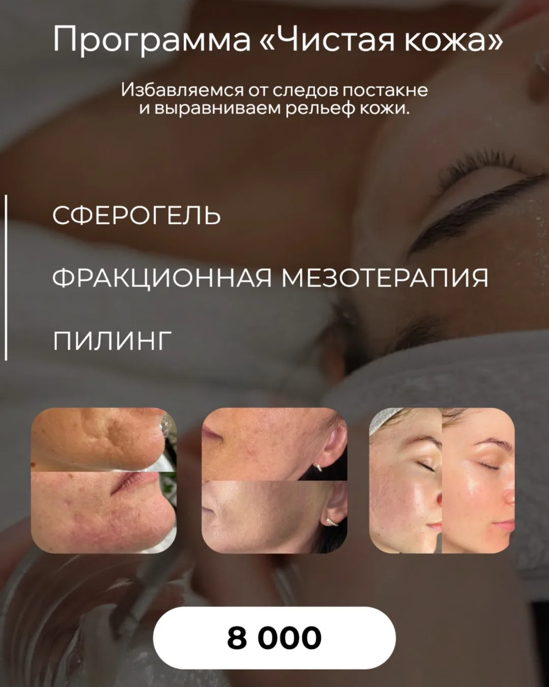 ✨ Программа «Чистая кожа»