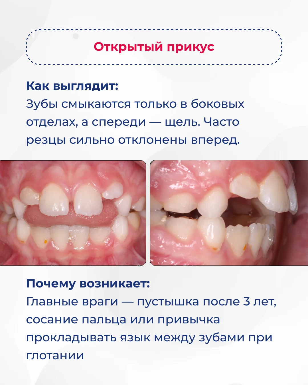 Листайте карусель ➡️  Заметили у своего ребенка один из этих признаков? Запишитесь на консультацию к