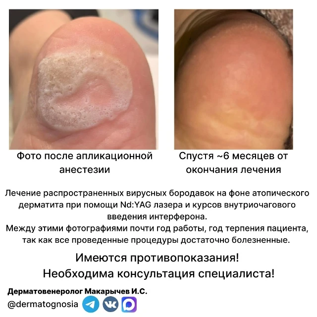 Вирусные бородавки - неопасные, но крайне неприятные образования кожи, вызванные вирусо...