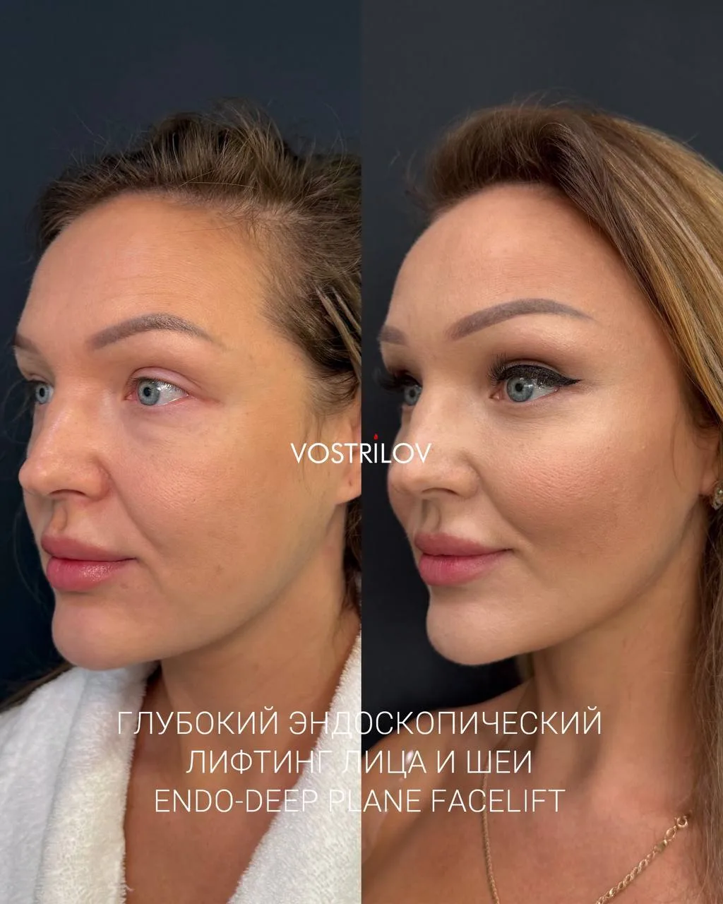 ❓Почему об эндоскопическом Deep Plane Facelift сегодня говорят во всем мире