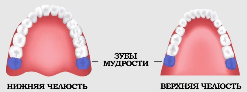 Почему у некоторых зубов мудрости вообще нет