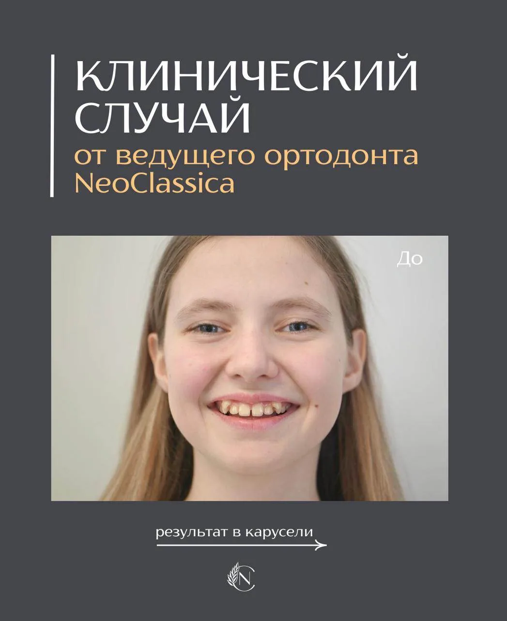 Дистальный прикус и дефицит места для клыков на верхней челюсти: как мы исправили ситуацию за полтор